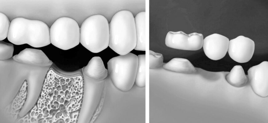 препарирование зубов рядом с дефектом